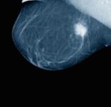 Breast tumour on a mammogram