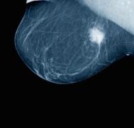 Breast tumour on a mammogram