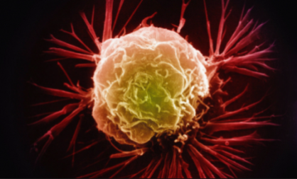 A false-colour electron micrograph image of a breast cancer cell.